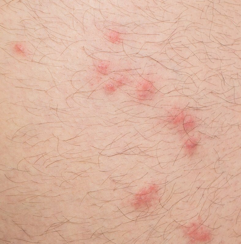 Flea bites on human skin - often found around ankles or areas close to contact with soft furniture - are signs of Flea infestation.